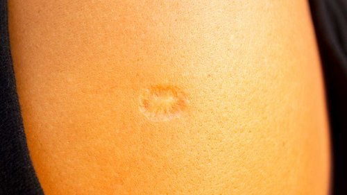 women-Smallpox-vaccine-scar.jpg